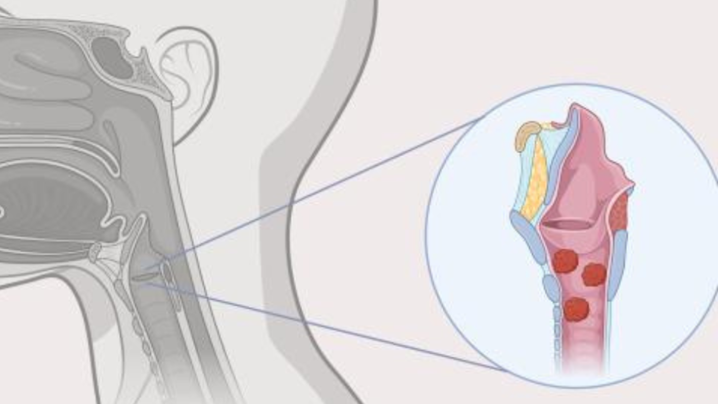 People with RRP develop small, wart-like growths (papillomas) in the upper and lower airways and lungs that can obstruct breathing and lead to respiratory complications